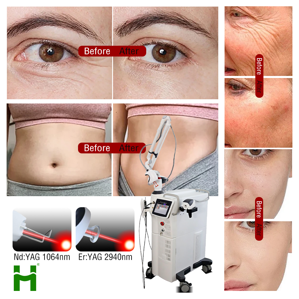 Fractional Laser Vaginal Tightening Scar Removal 2940nm Er Yag 1064nm Fractional 2940nm Erbium Yag Laser Machine